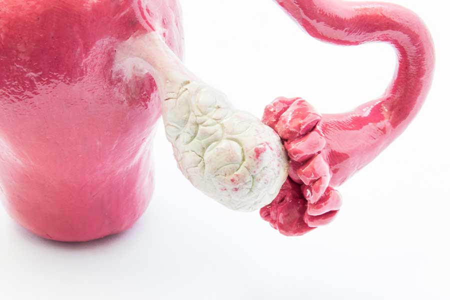 Yumurtalık Kisti Tedavisi: Ameliyat Şart mı? Tedavi Yöntemleri ve Merak Edilenler